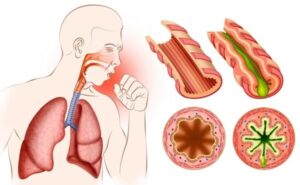 Aetiology of Asthma Bronchitis