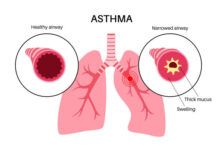 Asthma Bronchitis Breathing Beyond Limits